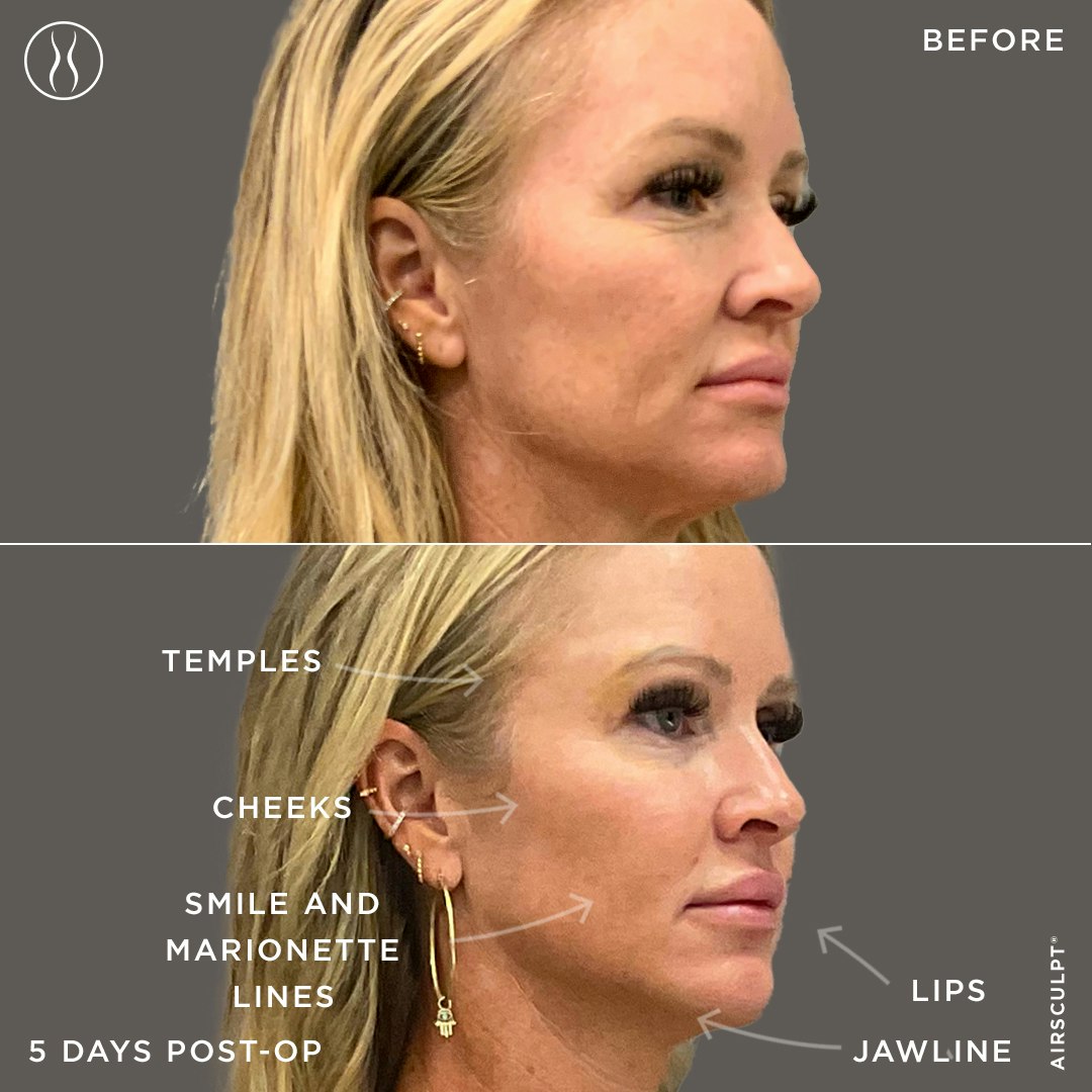 fat transfer to the face 5 day before and after image