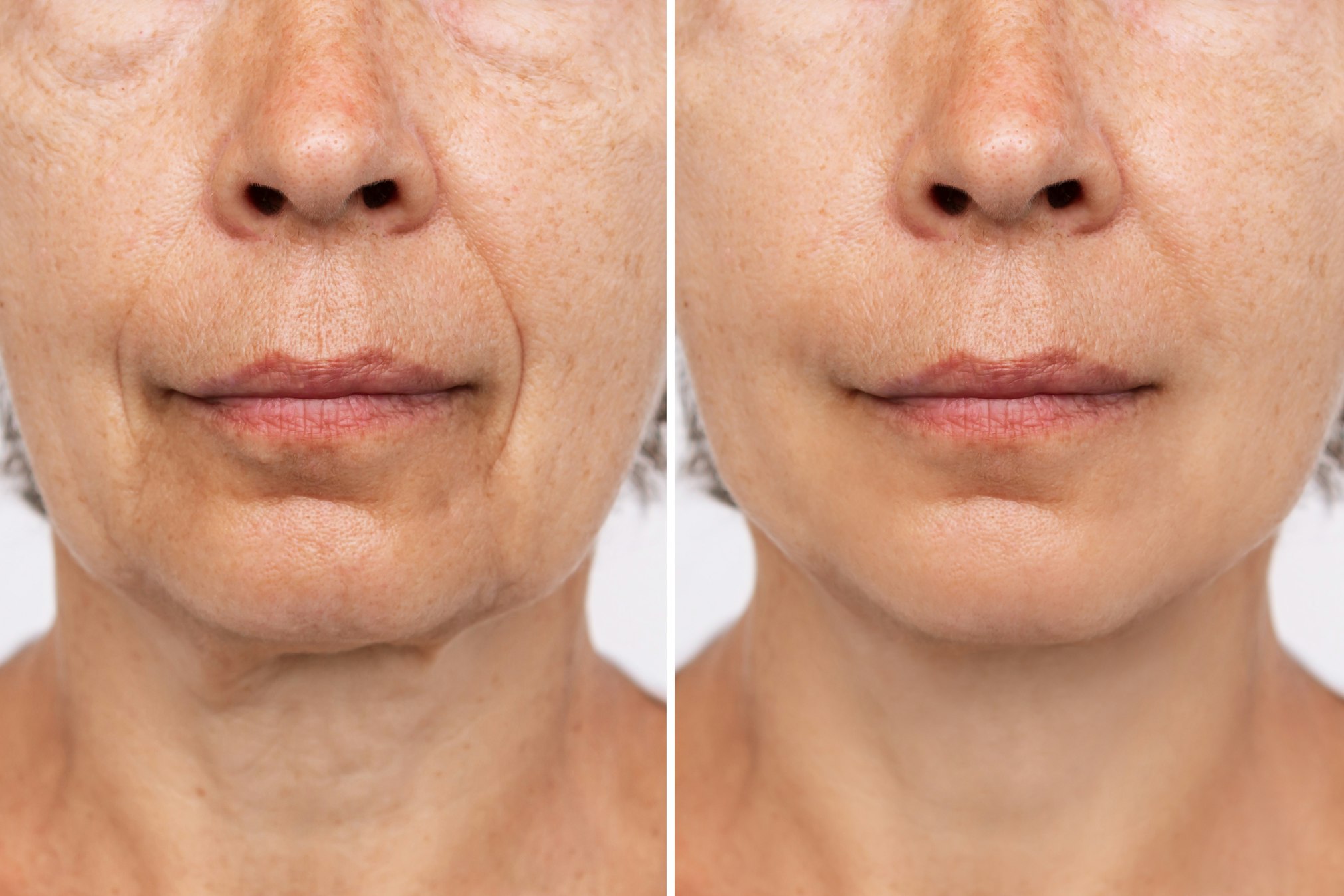 Lower part of face and neck of an elderly woman with signs of skin aging before after facelift, plastic surgery. Age-related changes, flabby sagging skin, wrinkles, creases, puffiness. Rejuvenation