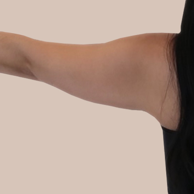 Madi Arm Pre-Op