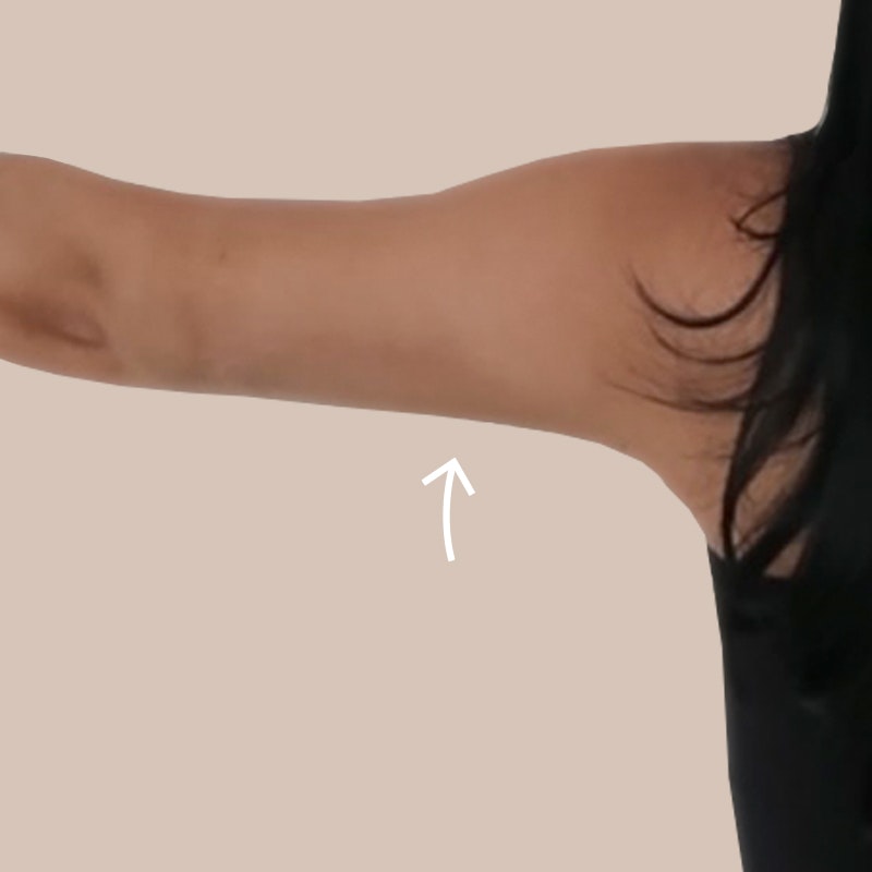 Madi Arm Post-Op