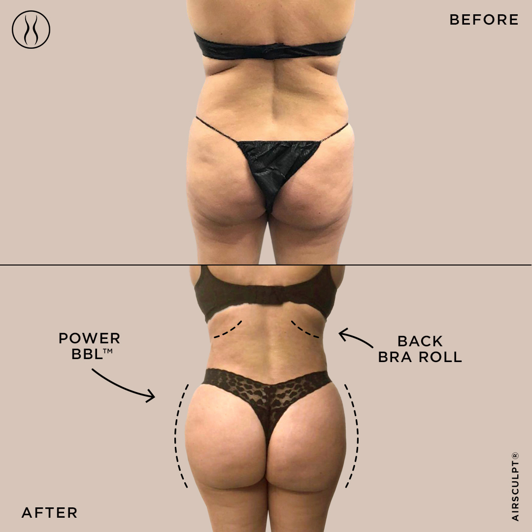 How To Achieve Natural BBL Surgery Results Seamlessly