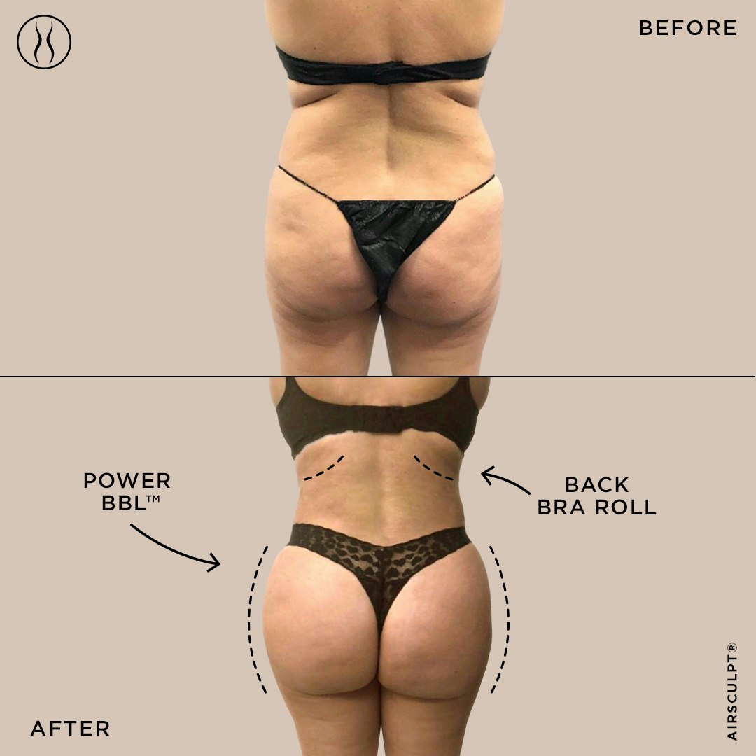 AirSculpt natural BBL before and after image