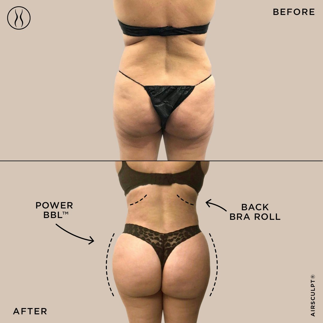 Buttock Lift - Achieve the Perfect Shape for Your Rear