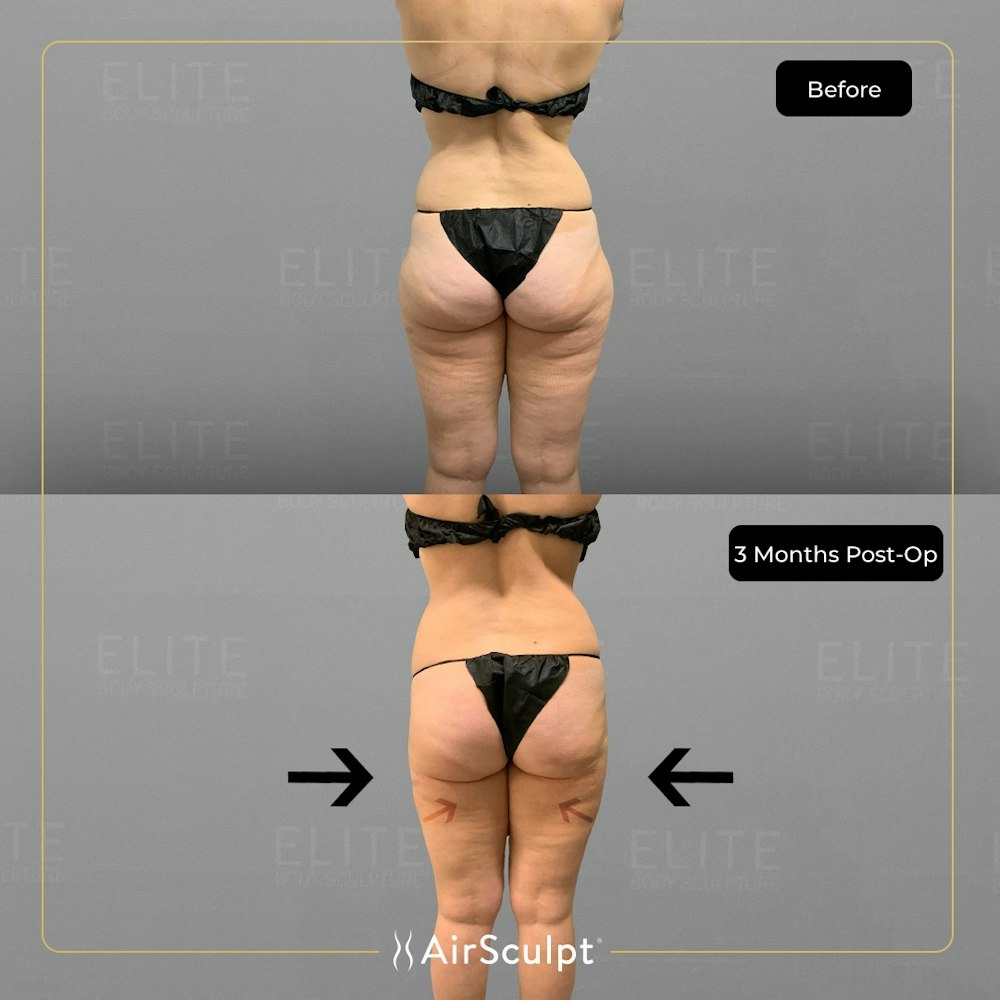 Outside thigh fat sale