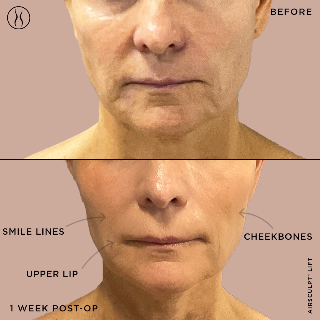 AirSculpt Lift Lip injection before and after 2