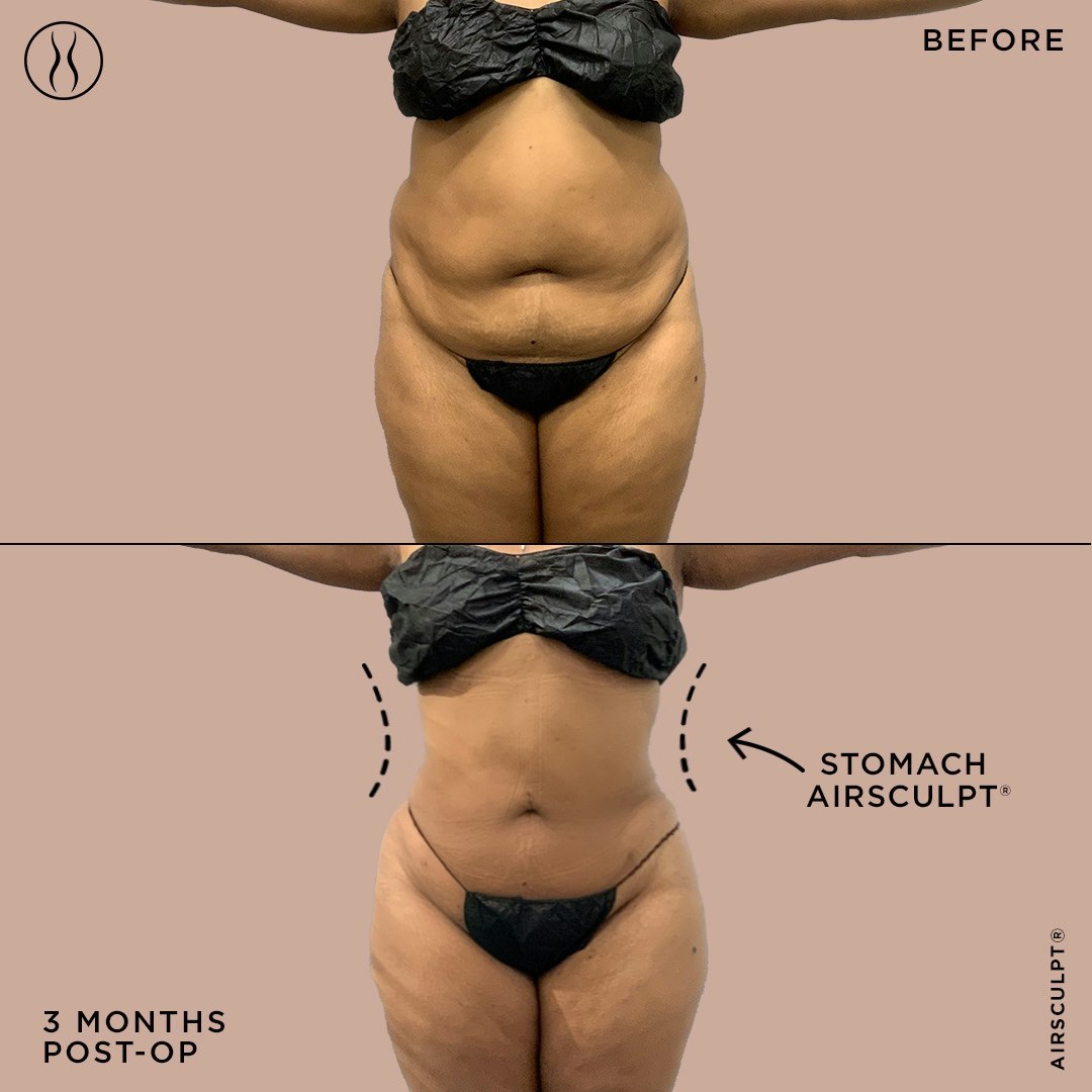 stomach fat removal before and after image