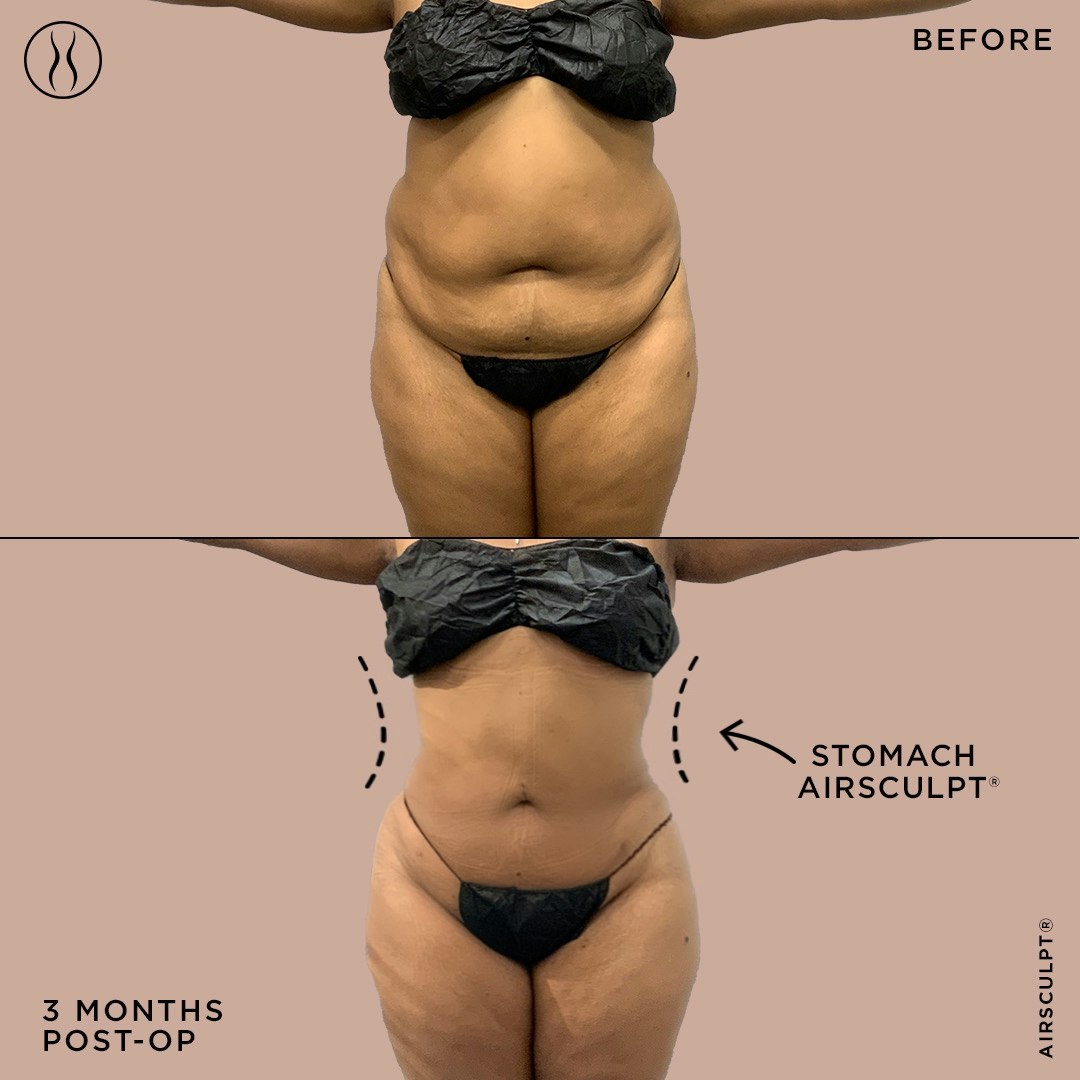 Diet, Exercise, And AirSculpt: 3 Ways to Lose Bra Bulge Fat