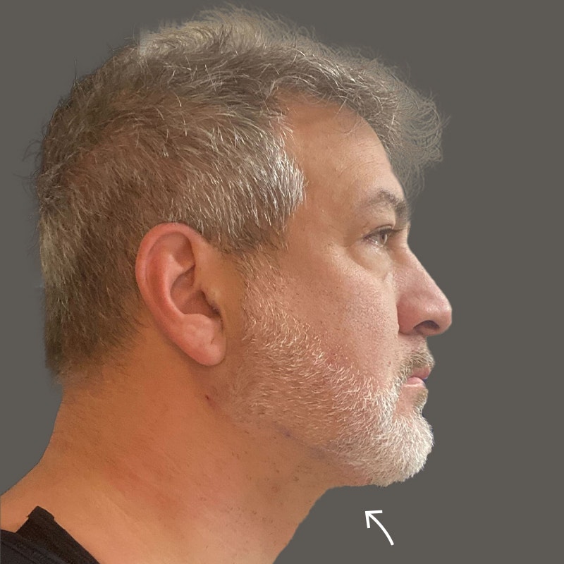 Joey Fatone After Chin AirSculpt