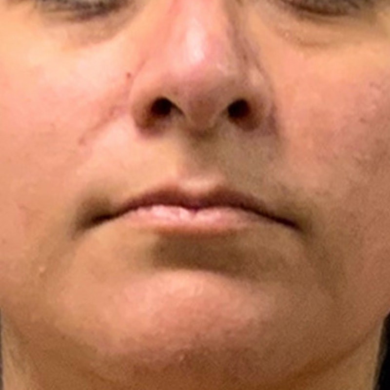 Before Airsculpt