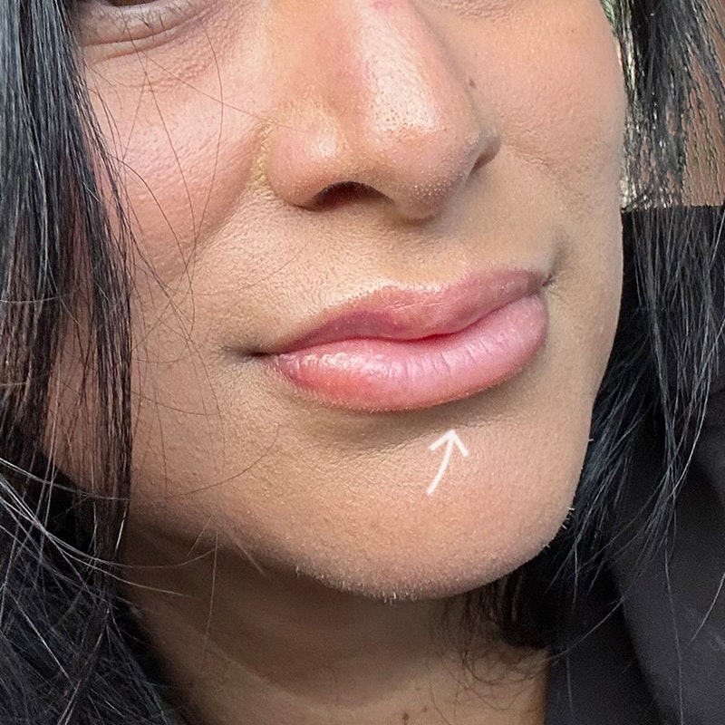 After AirSculpt