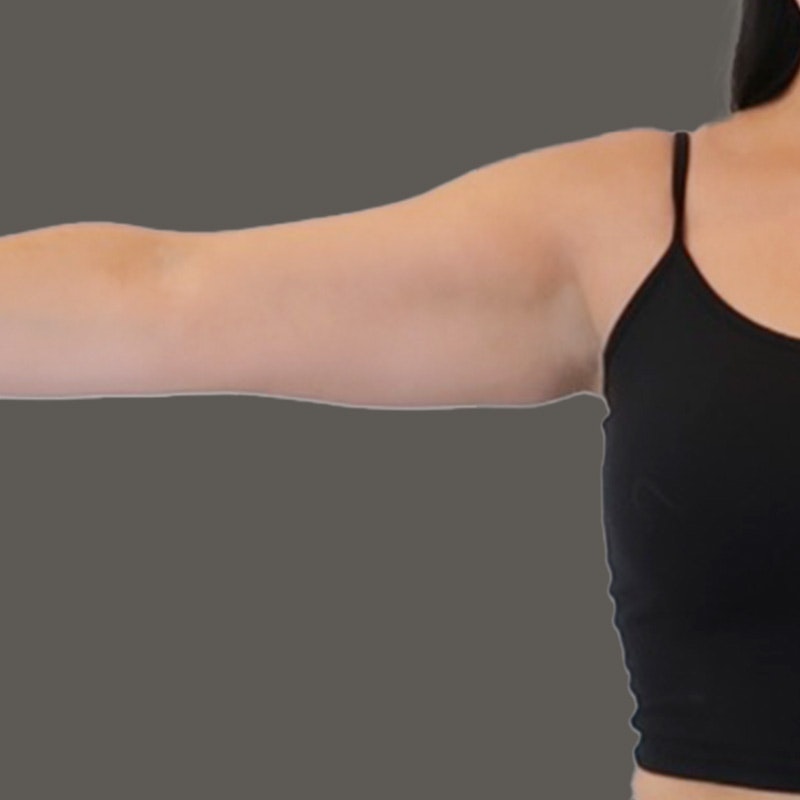 Before Airsculpt