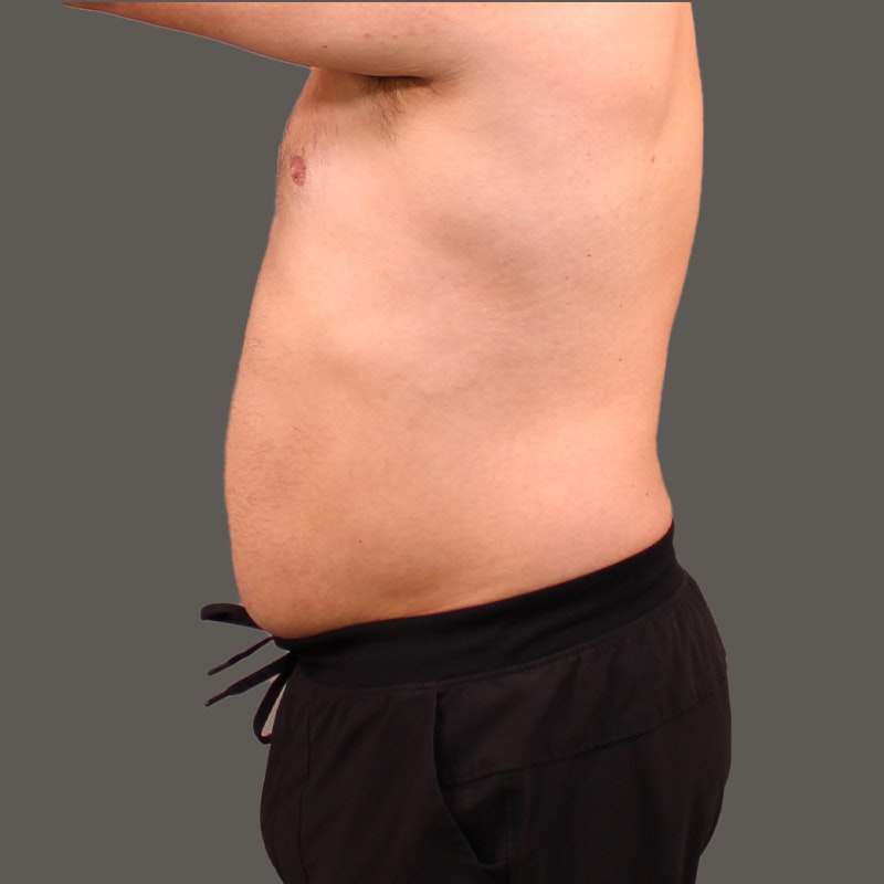 Boston Mons Pubis Liposuction  AirSculpt® Pubic Fat Removal
