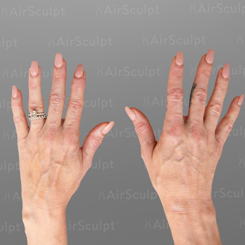 Before Airsculpt