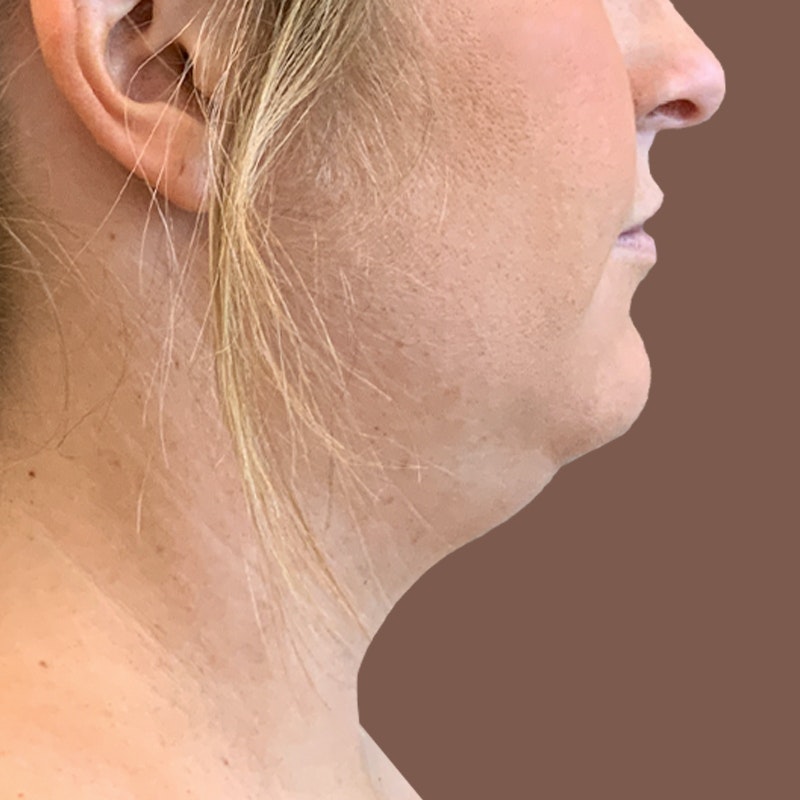 Before Airsculpt