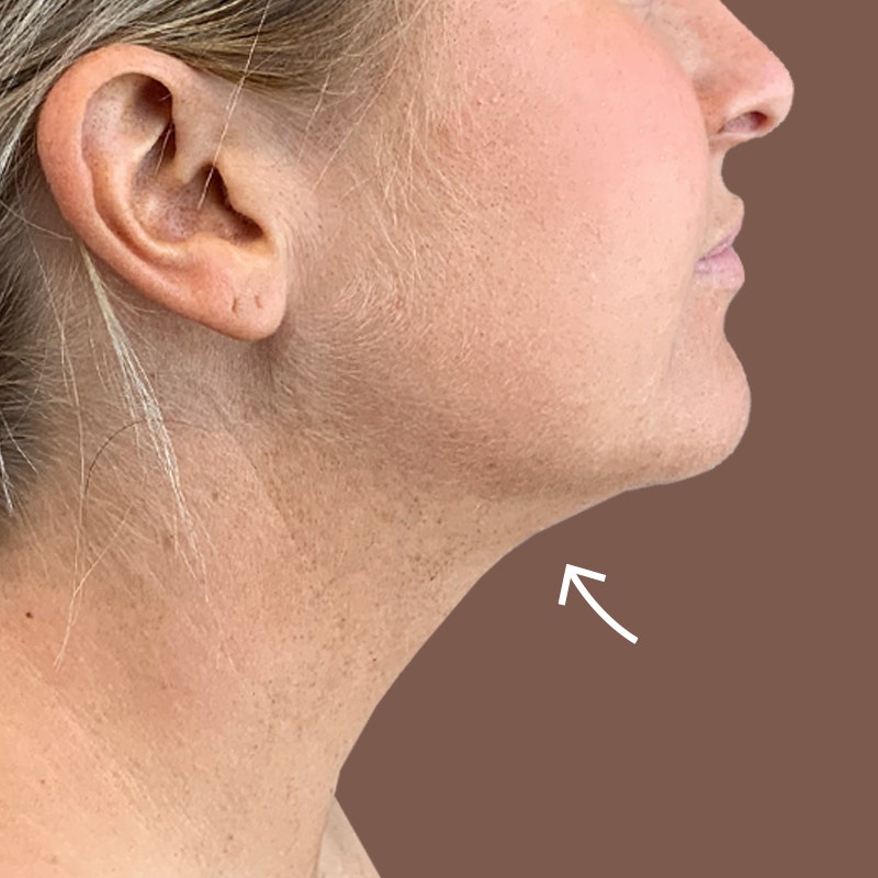 After AirSculpt