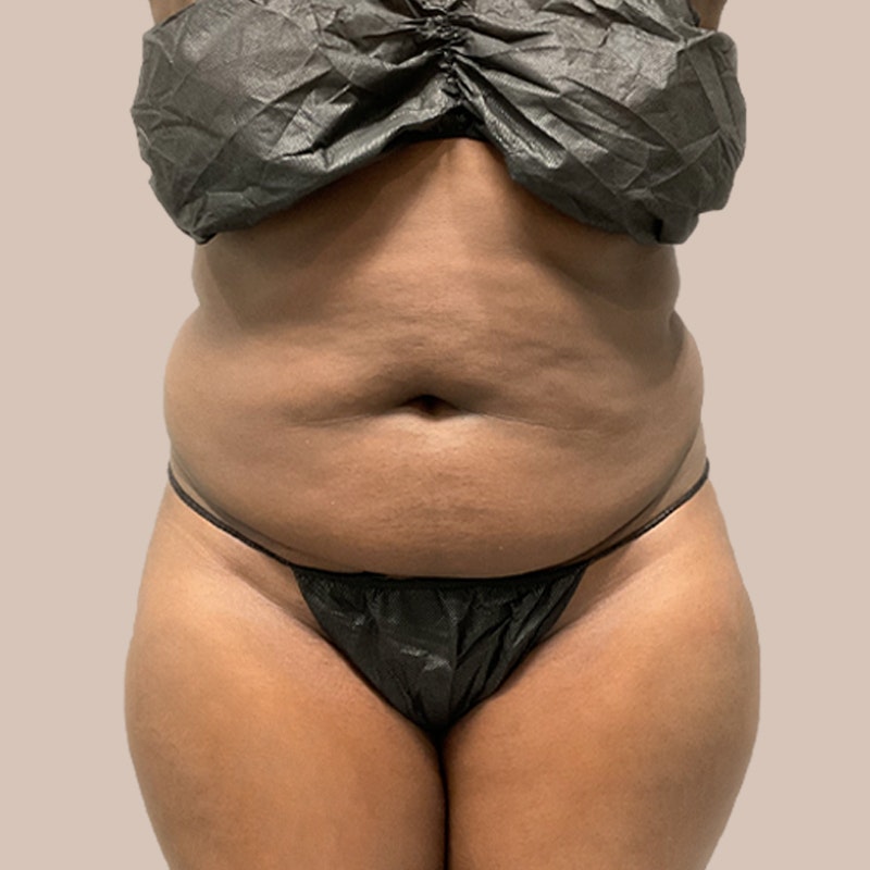 Before Airsculpt