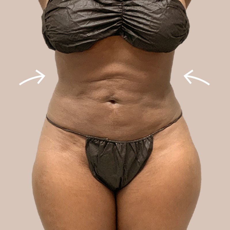 A Flatter Tummy and Naturally Enhanced Breasts: What AirSculpt Did For This  San Diego Patient