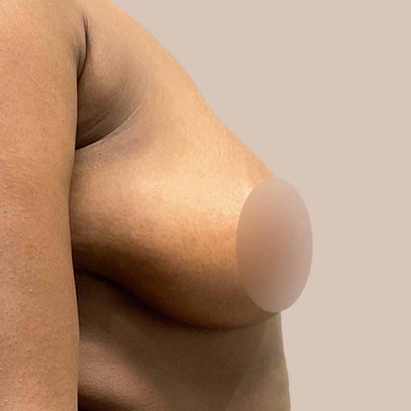 Before Airsculpt
