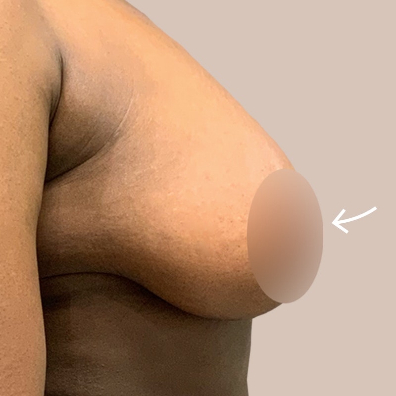 After AirSculpt