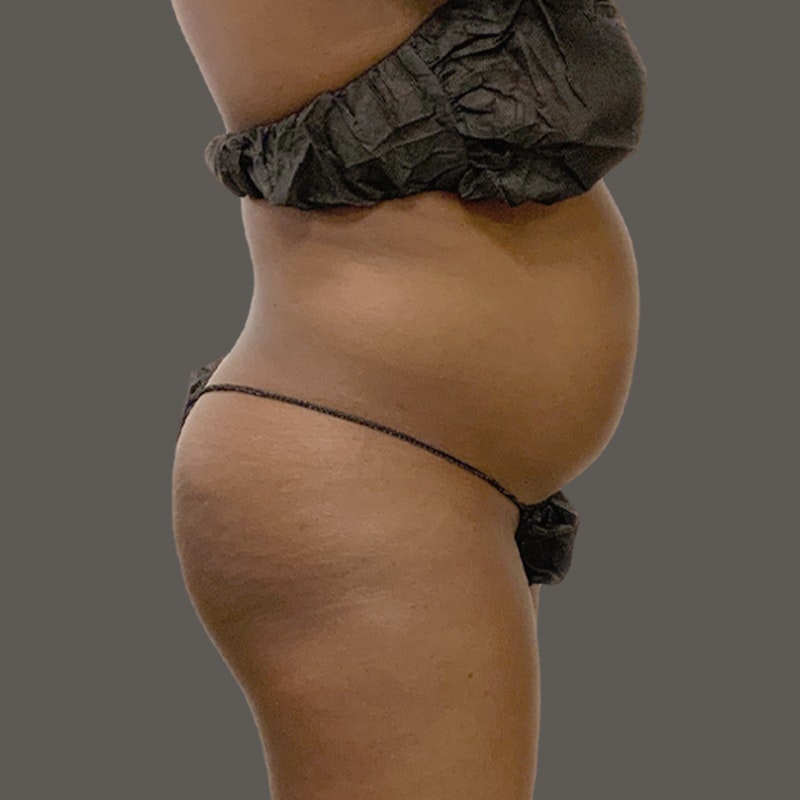 Before Airsculpt