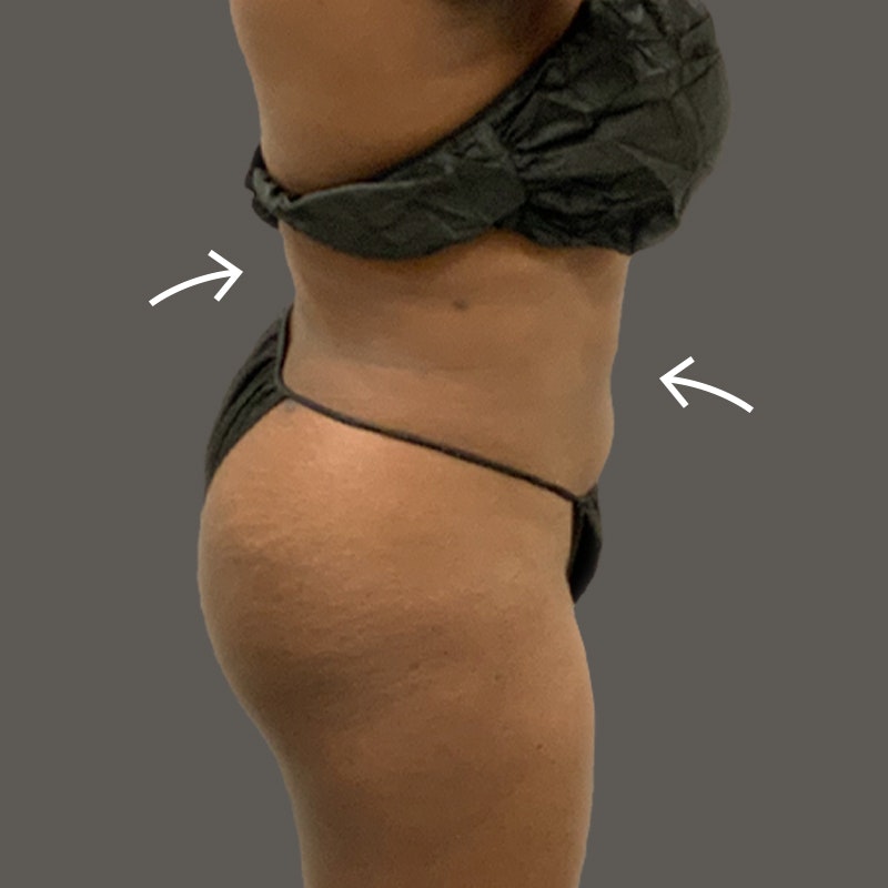 After AirSculpt