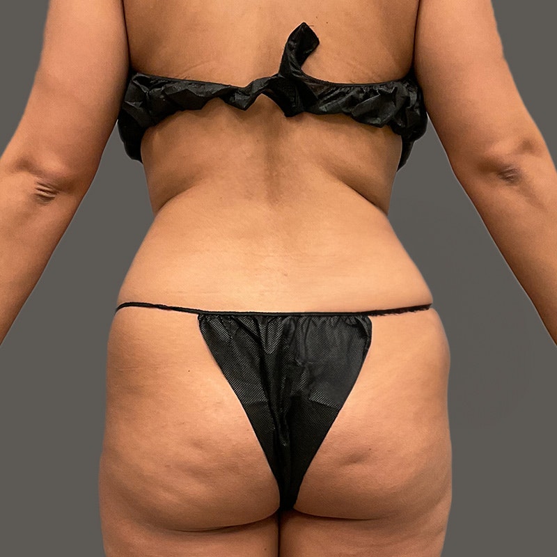 Before Power BBL AirSculpt