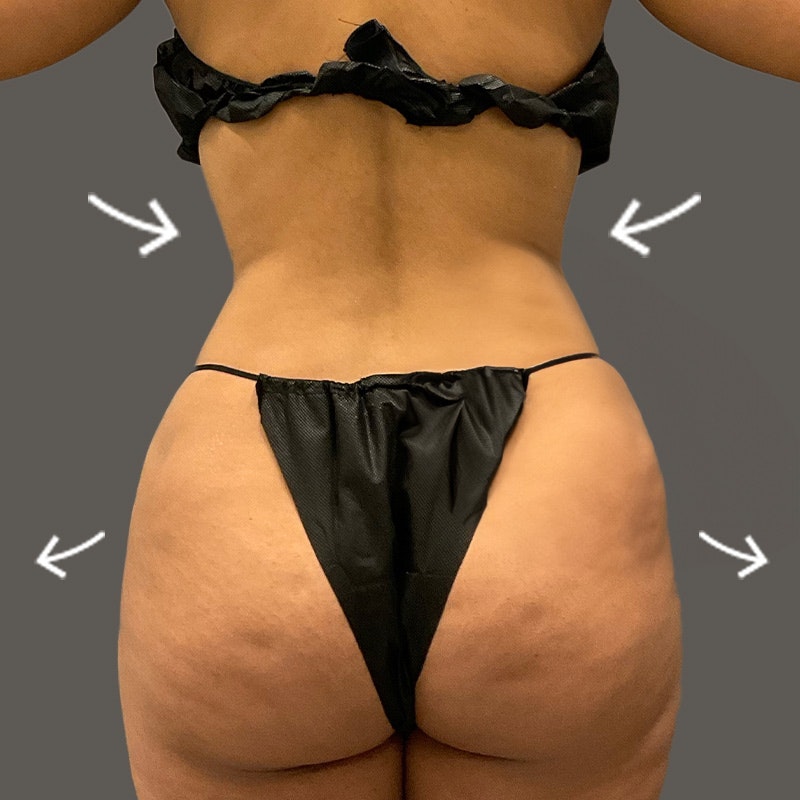 After Power BBL AirSculpt