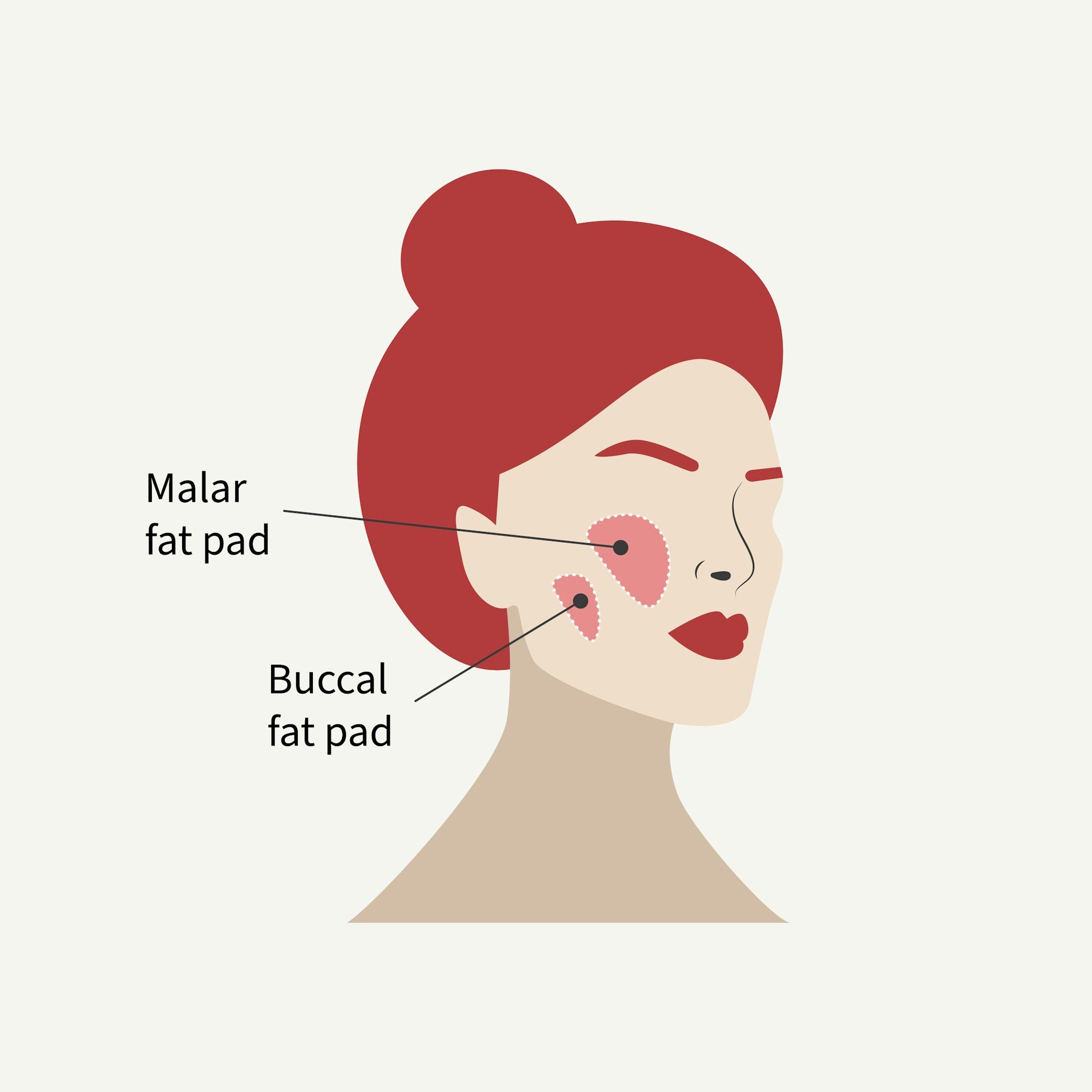 Removal of malar fat pad and buccal fat pad