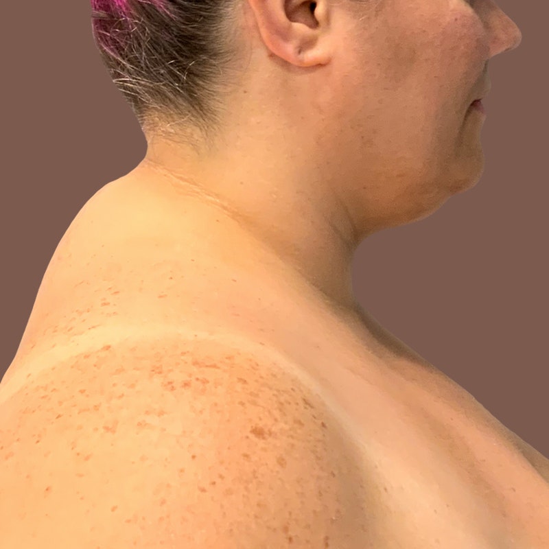 Chin Before Airsculpt
