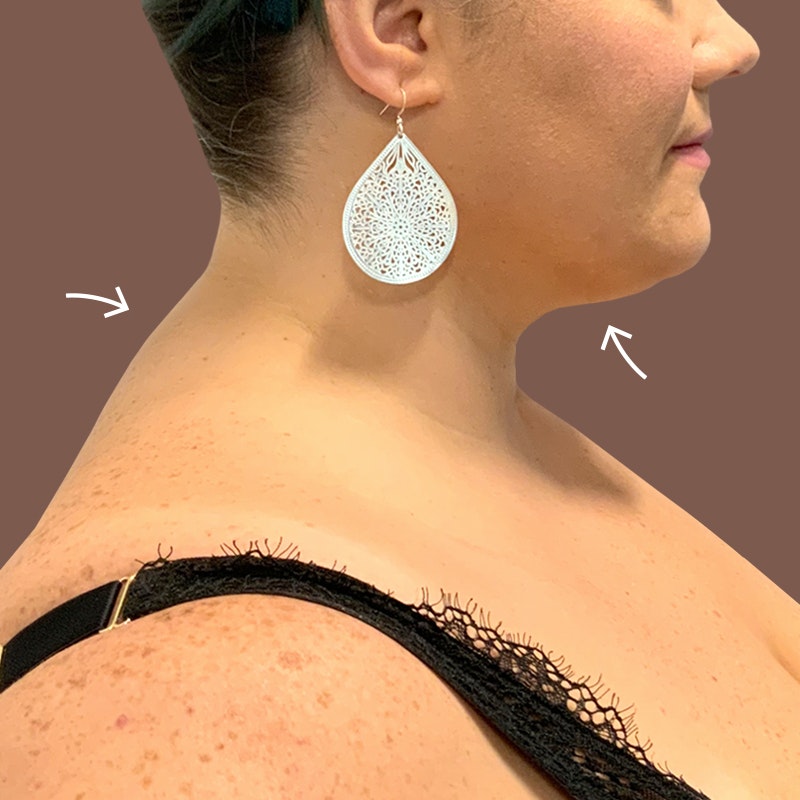 Chin After AirSculpt
