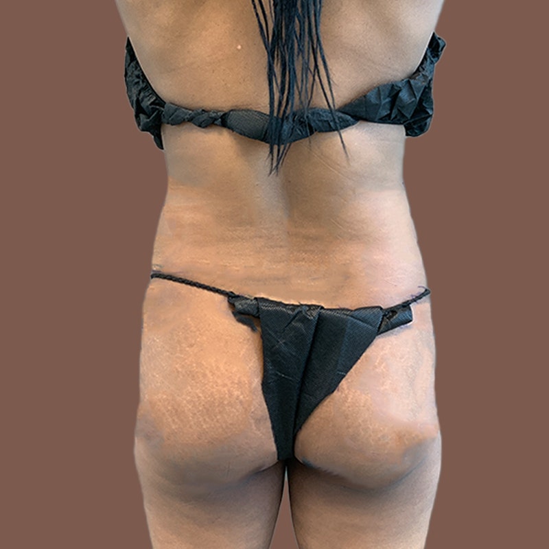 Butt before Airsculpt