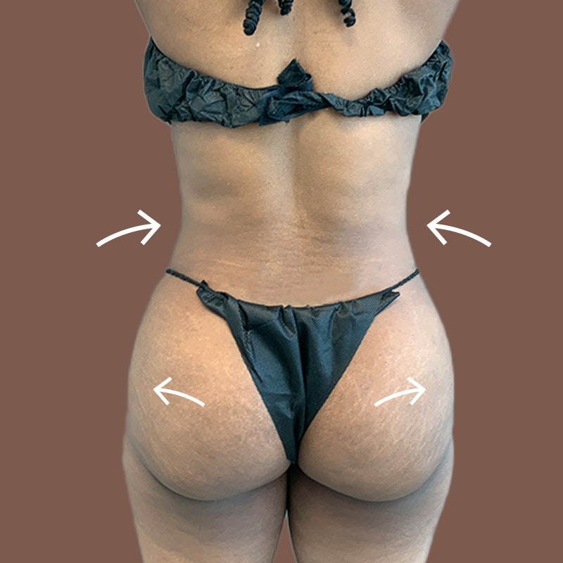 Butt after airsculpt