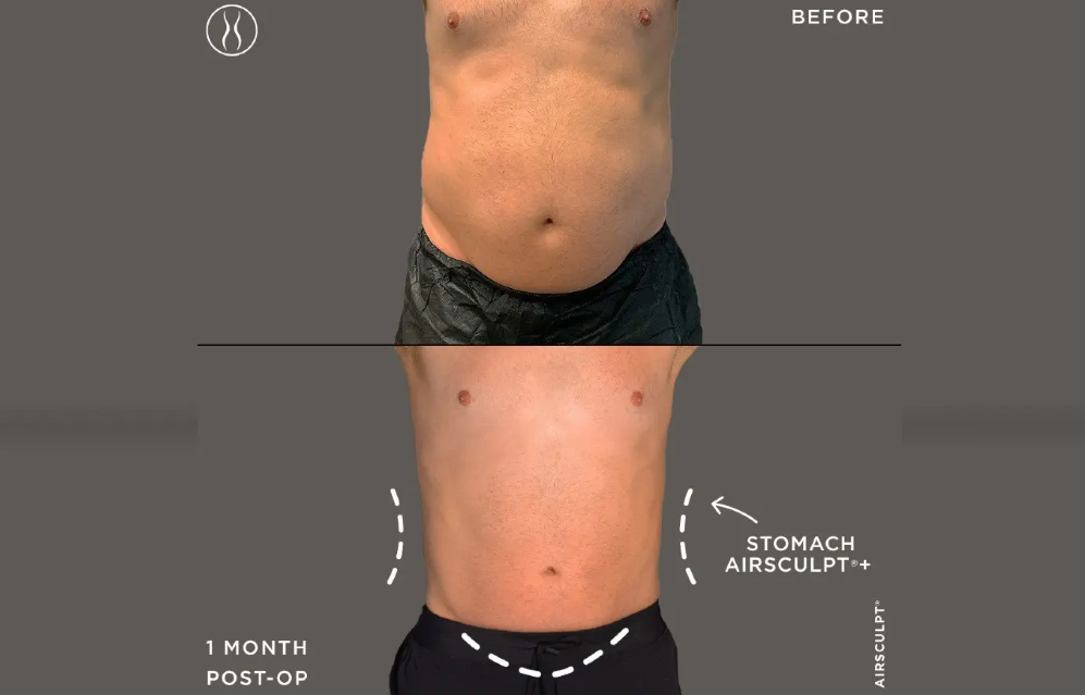joey before and after