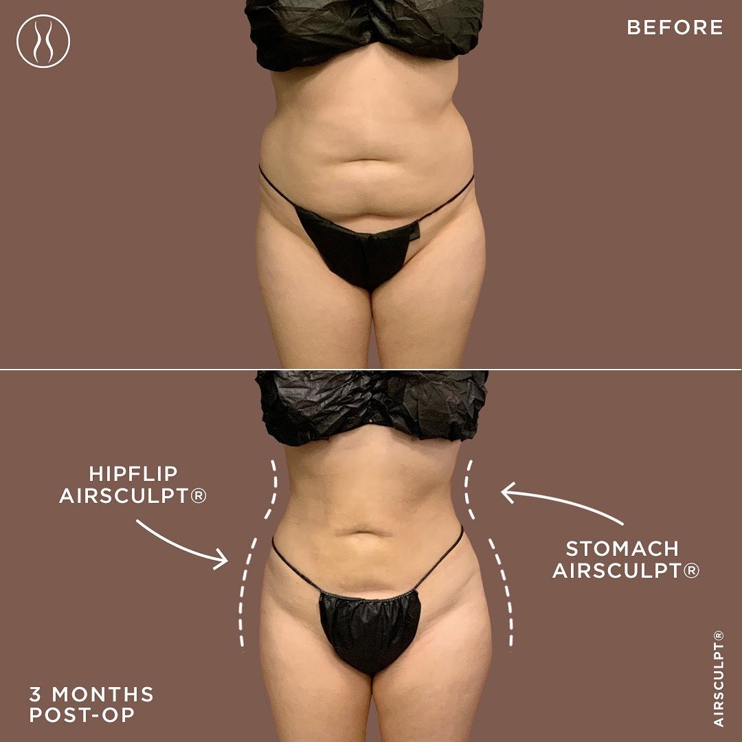 muffin top removal before and after 
