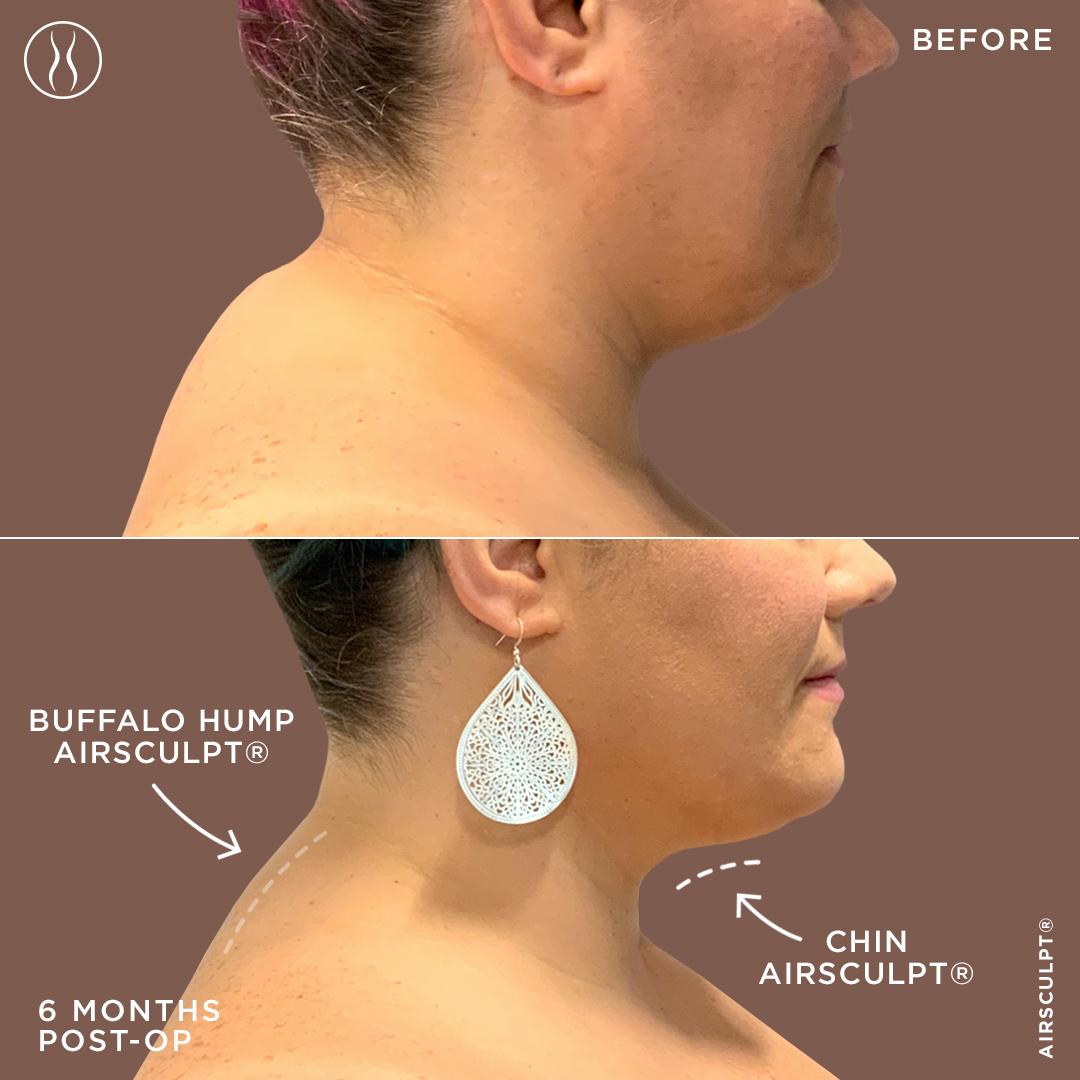 buffalo hump removal before and after