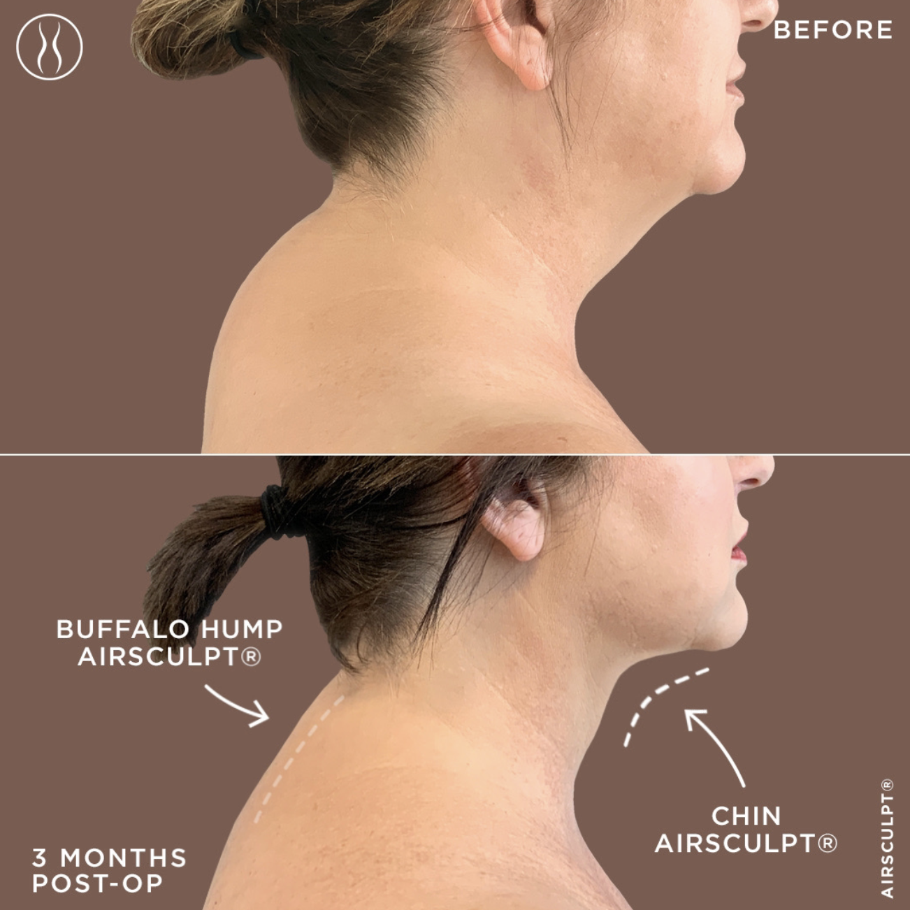 Neck and Buffalo Hump Causes and Other Key Information