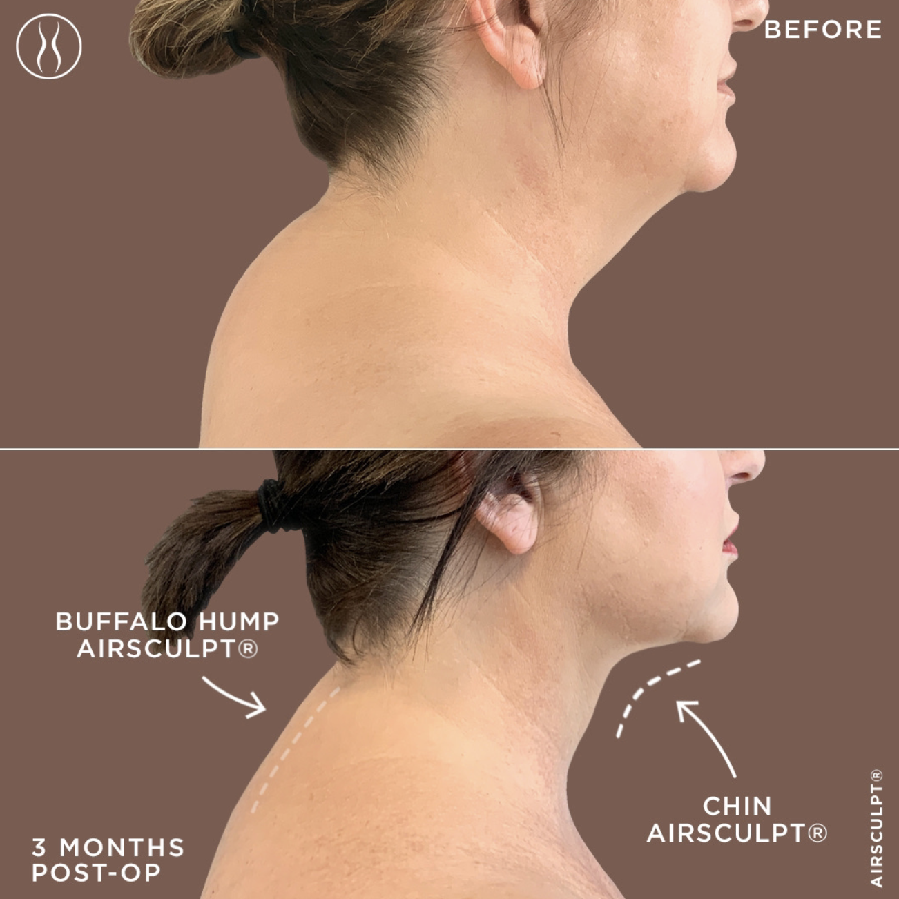 buffalo hump removal before and after