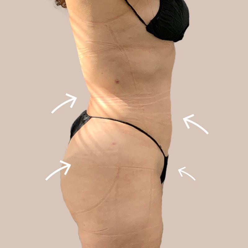 hips after airsculpt