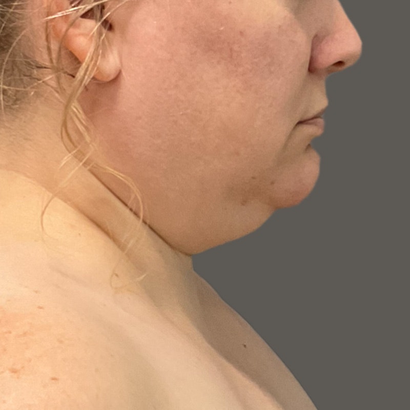 Before Chin AirSculpt