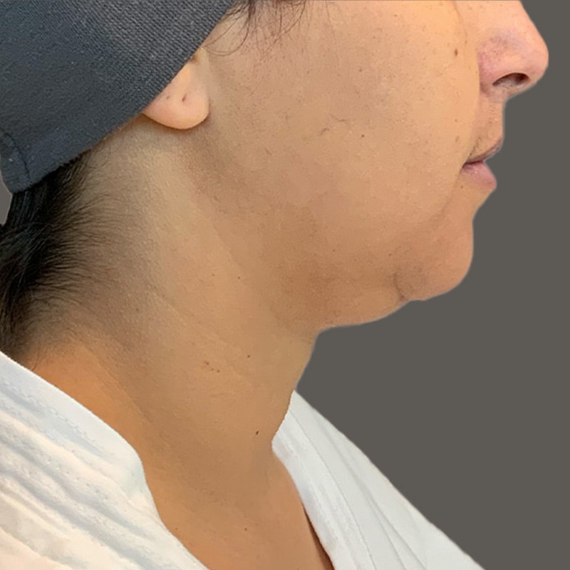 Chin Before Airsculpt
