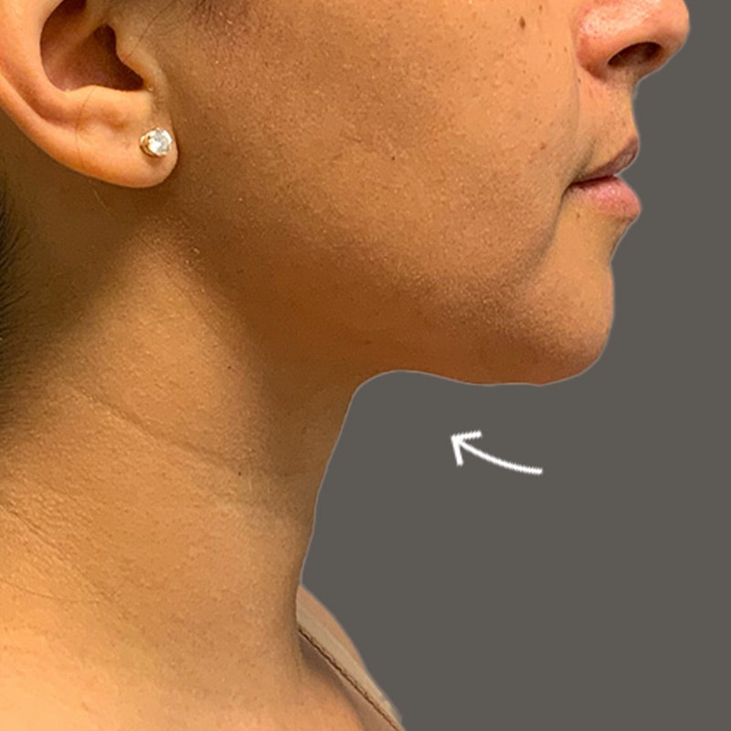 Chin After AirSculpt