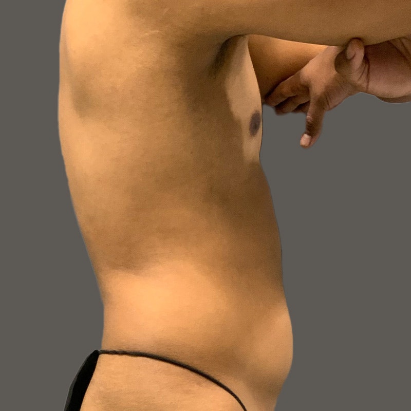 Stomach before Airsculpt