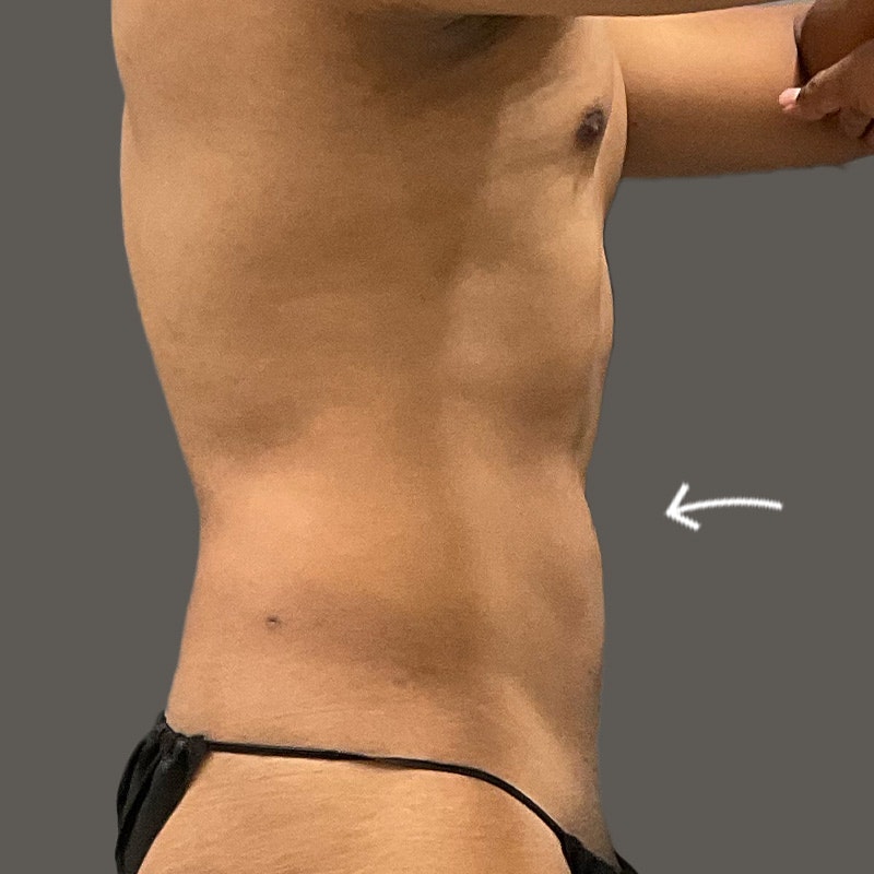 Stomach after AirSculpt
