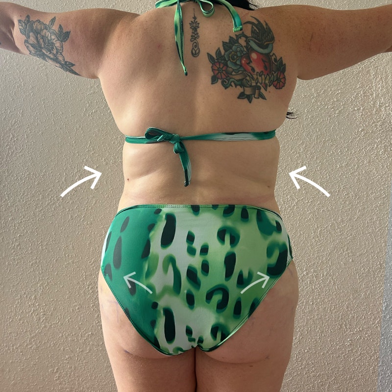Hannah Swimsuit 1 Week after Airsculpt