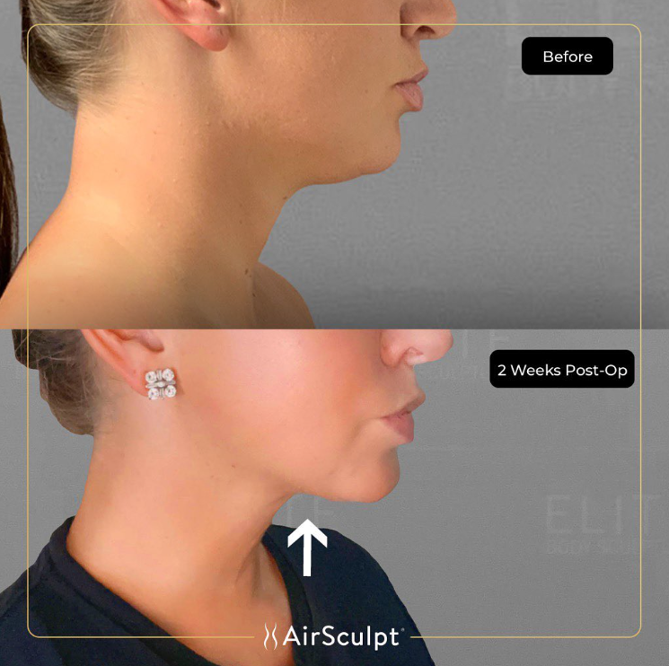 airsculpt before and after