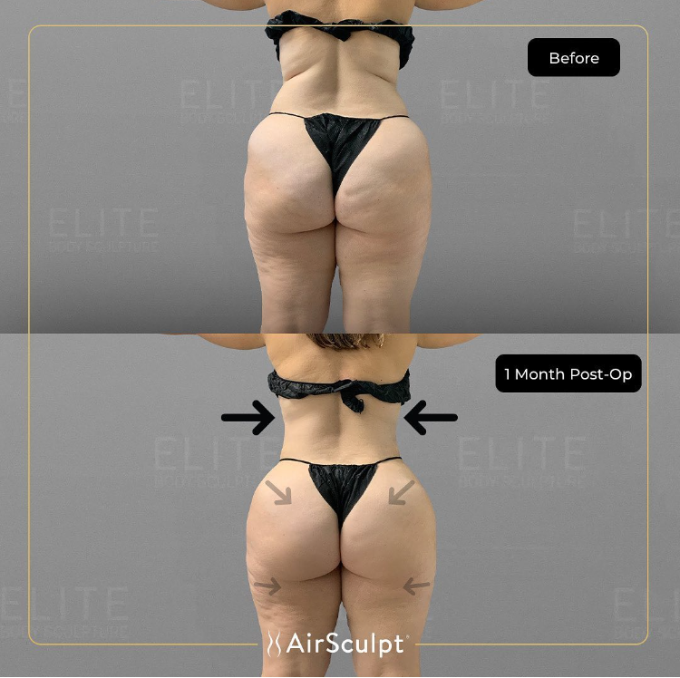 LA Weekly: AirSculpt® Away Stubborn Fat in Time For the New Year