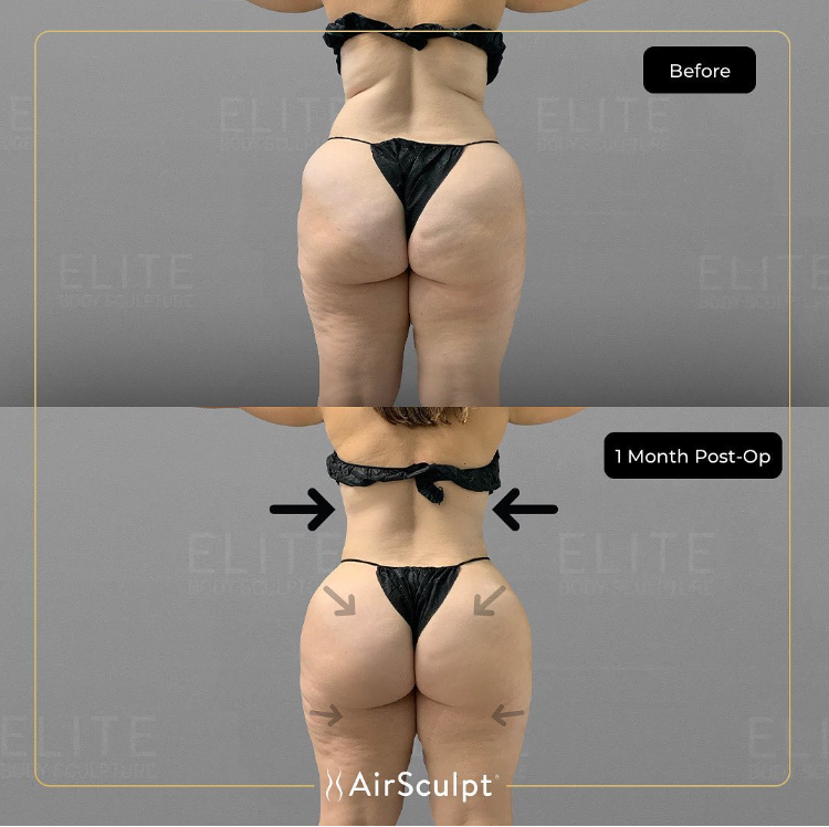 San Diego Breast Augmentation  AirSculpt® Implants Alternative