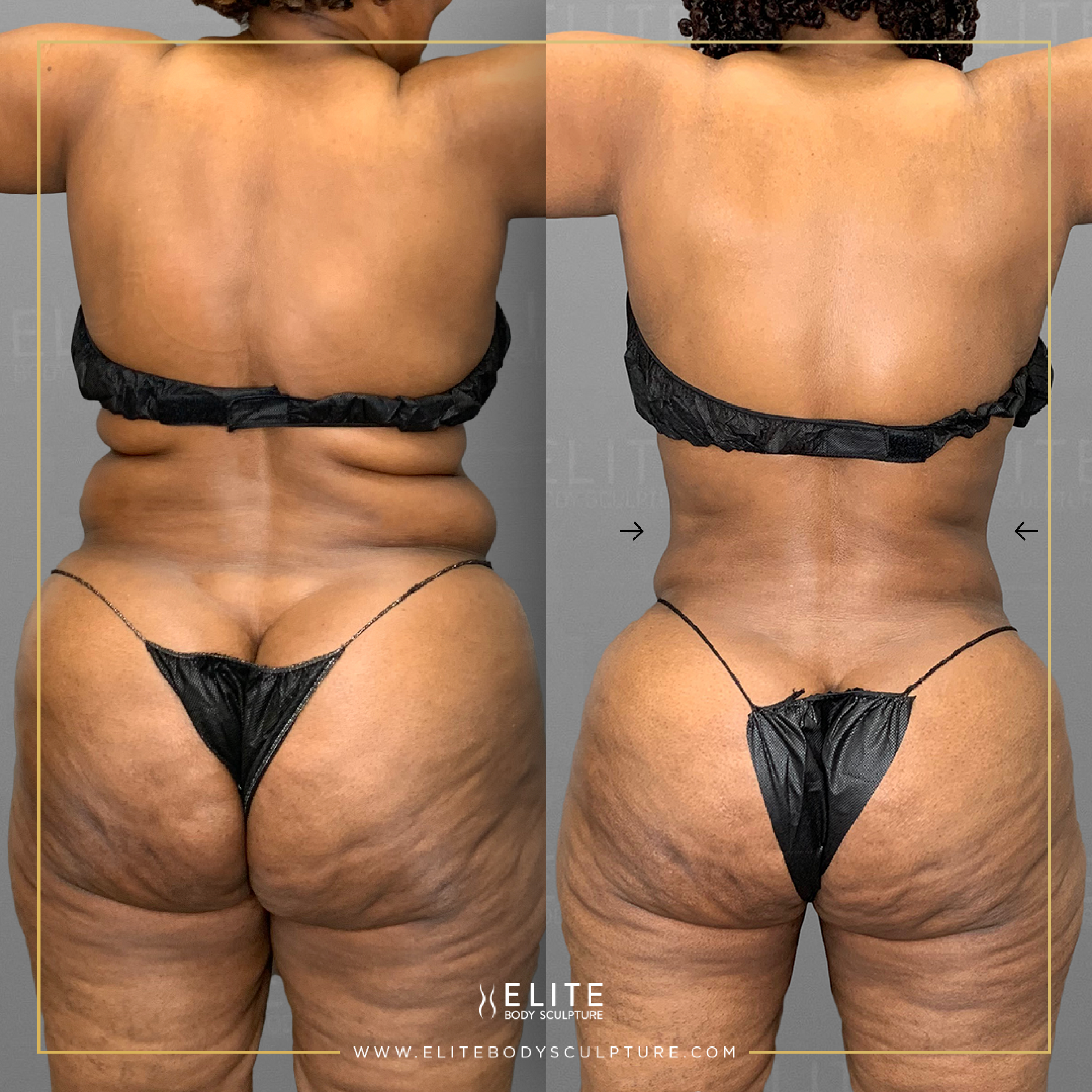thigh gap surgery before and after 