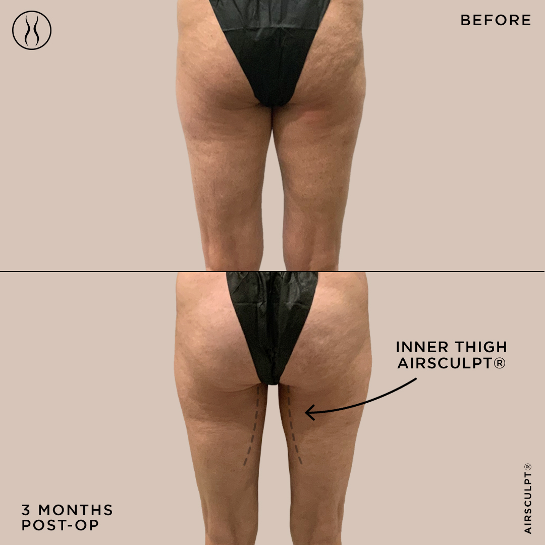 How is AirSculpt's Thigh Gap Surgery Different Than A Lift?