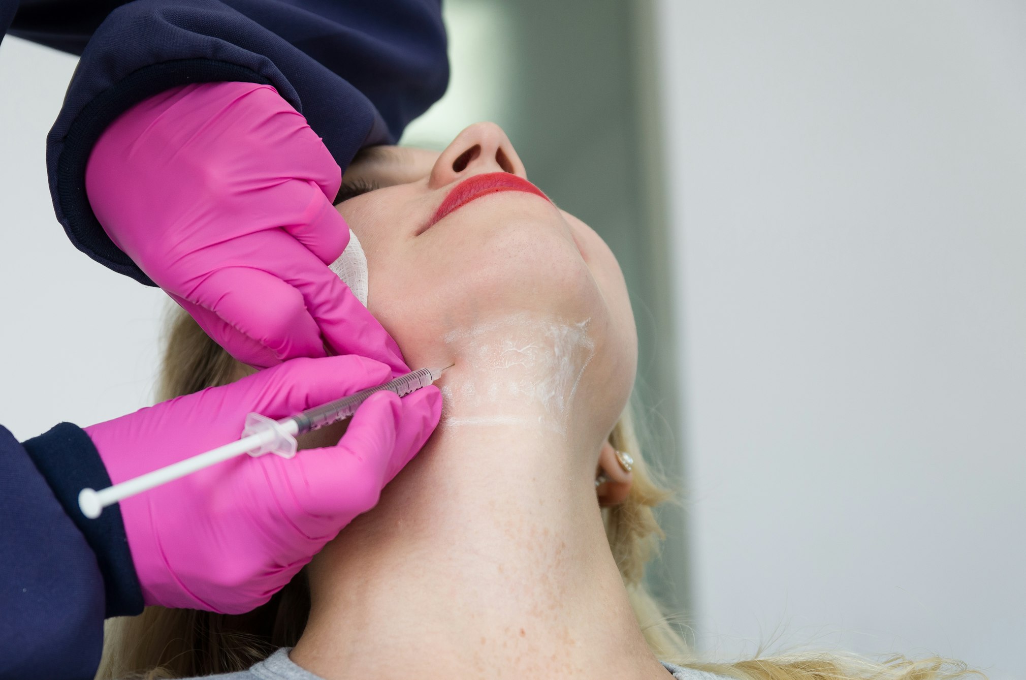 concept of aesthetic treatment of jowls, injection of deoxycholic acid.